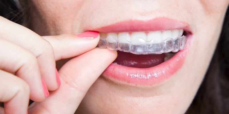 Why You Should Consider Clear Braces - Carolina Smiles Family Dental  Brevard North Carolina