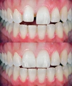 Veneers in Clayton, North Carolina