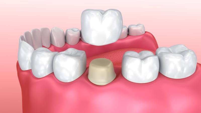 Same-day crowns can last 10 to 15 years or even longer with proper care