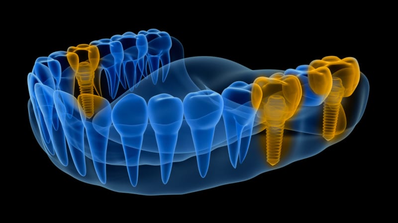 dental implants provide you with the closest experience to natural teeth