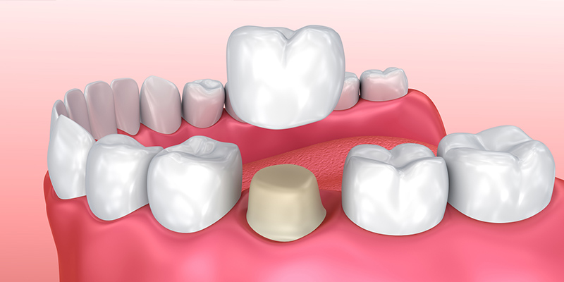 Same-Day Crowns: Can They be Done?