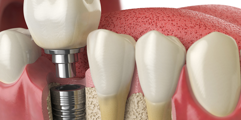 3 Benefits of Dental Implants that Can’t be Ignored