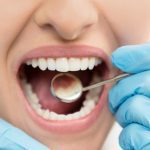 Tooth Bonding in Clayton, North Carolina