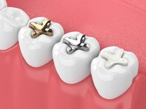 Why You Need Dental Fillings for Cavities