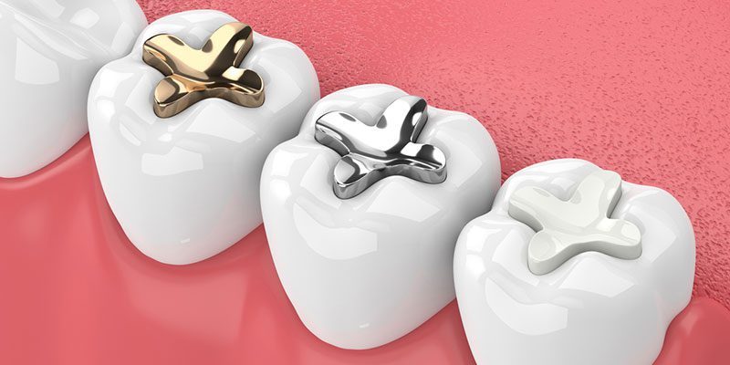 Why You Need Dental Fillings for Cavities