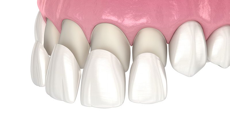 Intro to Dental Veneers