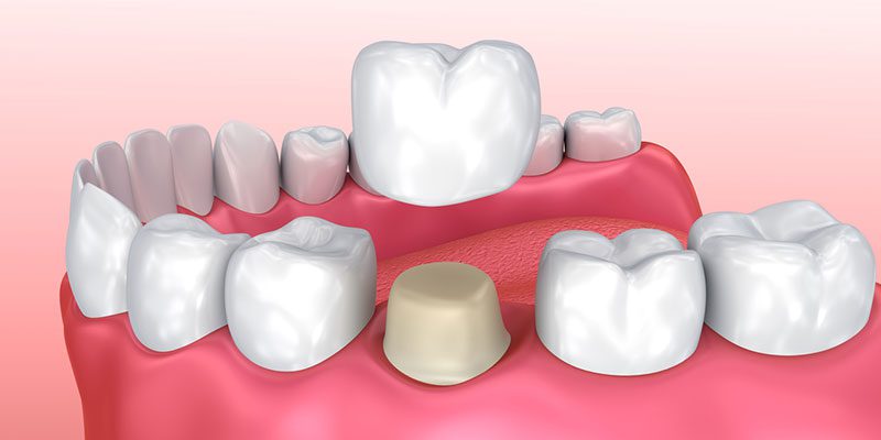 What You Need to Know About Dental Crowns