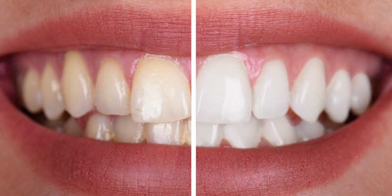 6 Common Causes of Yellow Teeth