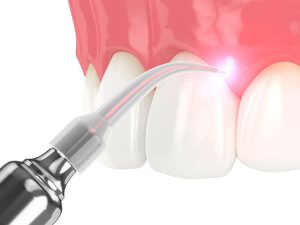 State-of-the-Art Dental Care: The Advantages of Laser Dentistry