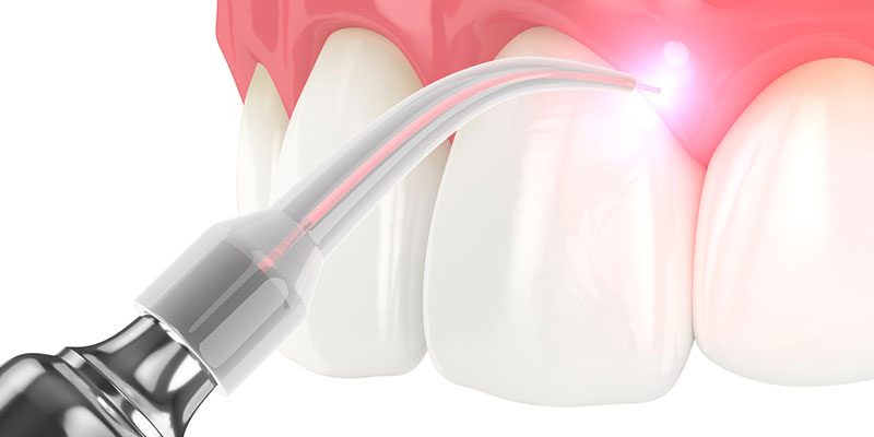 State-of-the-Art Dental Care: The Advantages of Laser Dentistry