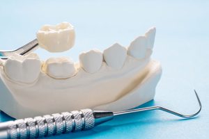 Enhance Your Smile with Same-Day Crowns: Experience the CEREC Advantage