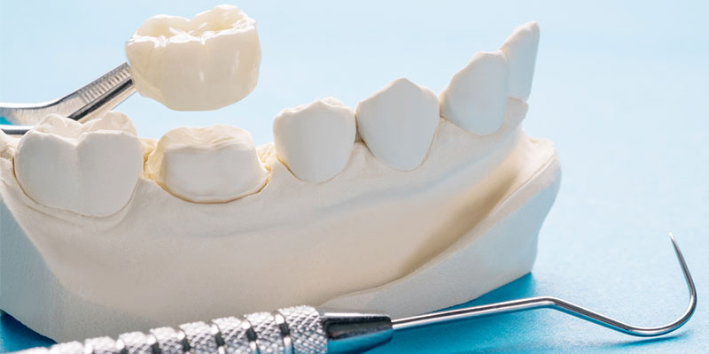 Enhance Your Smile with Same-Day Crowns: Experience the CEREC Advantage