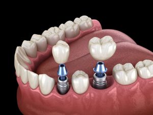 Understanding Dental Implants: Permanent Solutions for Missing Teeth
