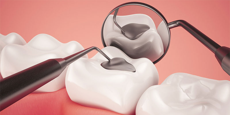 Preserving Your Smile: The Role of Dental Fillings in Oral Health