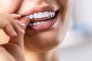 The Benefits of Going Incognito with Invisalign